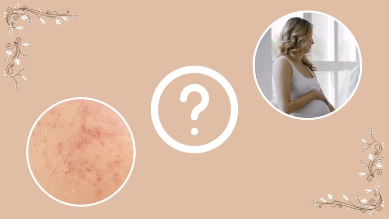 FAQs About Body Acne During Pregnancy