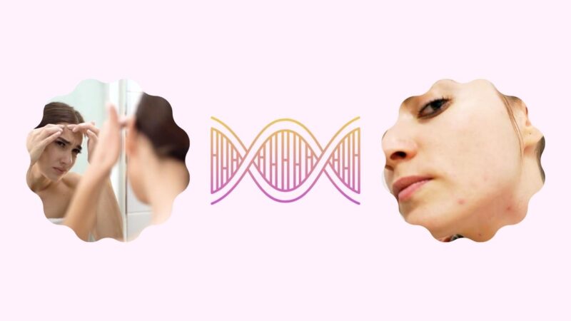 The Role of Genetics in Pregnancy Acne