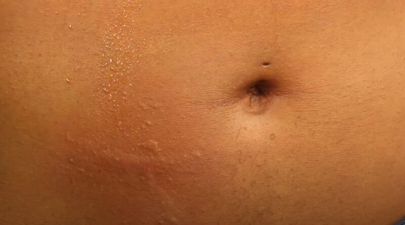 Does Poor Hygiene Cause Acne on Stomach