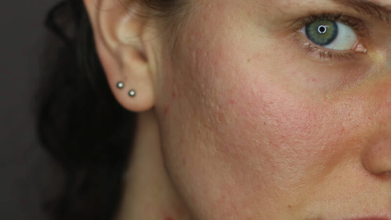 Acne Scars - Why Do They Happen